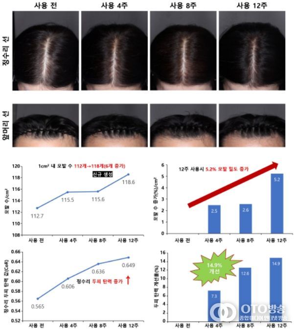 모발 밀도와 두피 탄력 개선